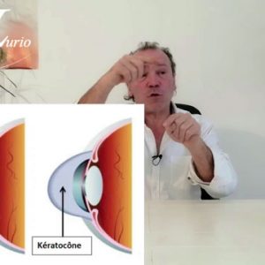 Le kératocône