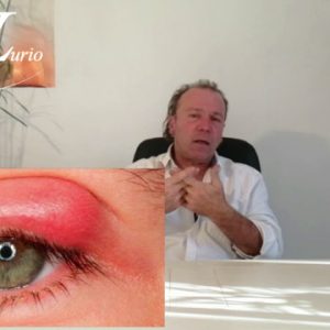 Le chalazion